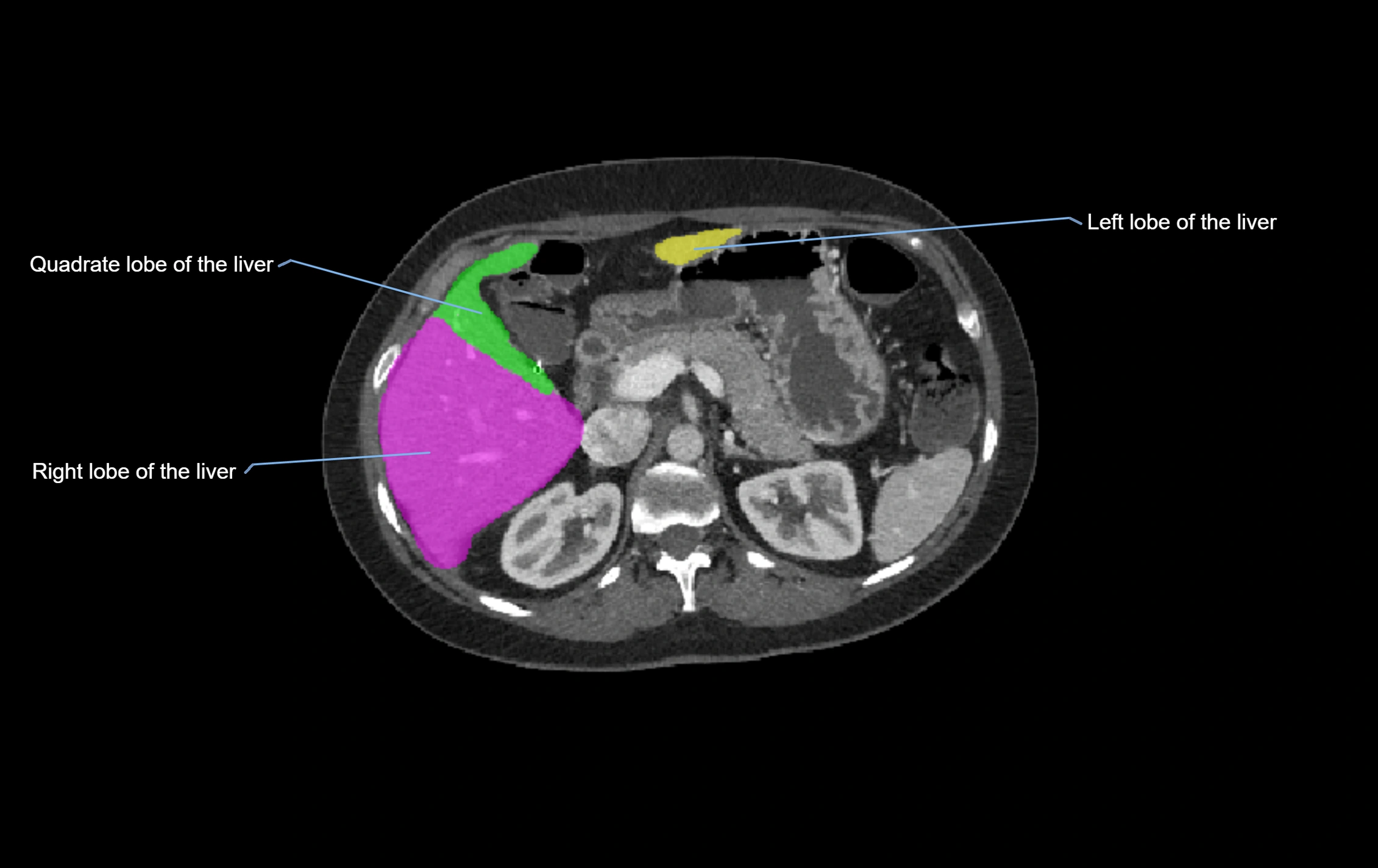 CT lliver lobes axial cross sectional anatomy labelled image -00038.webp